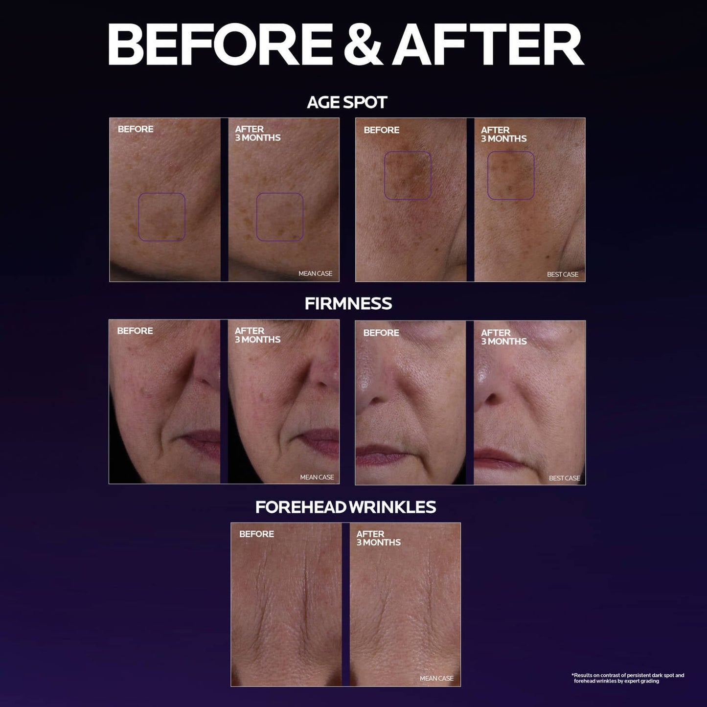 mela-b3-double-dose-discoloration-treatment-with-melasyltm-w6 MelaB3_DD_BTF_BeforeAfter_1500x1500_5.jpg