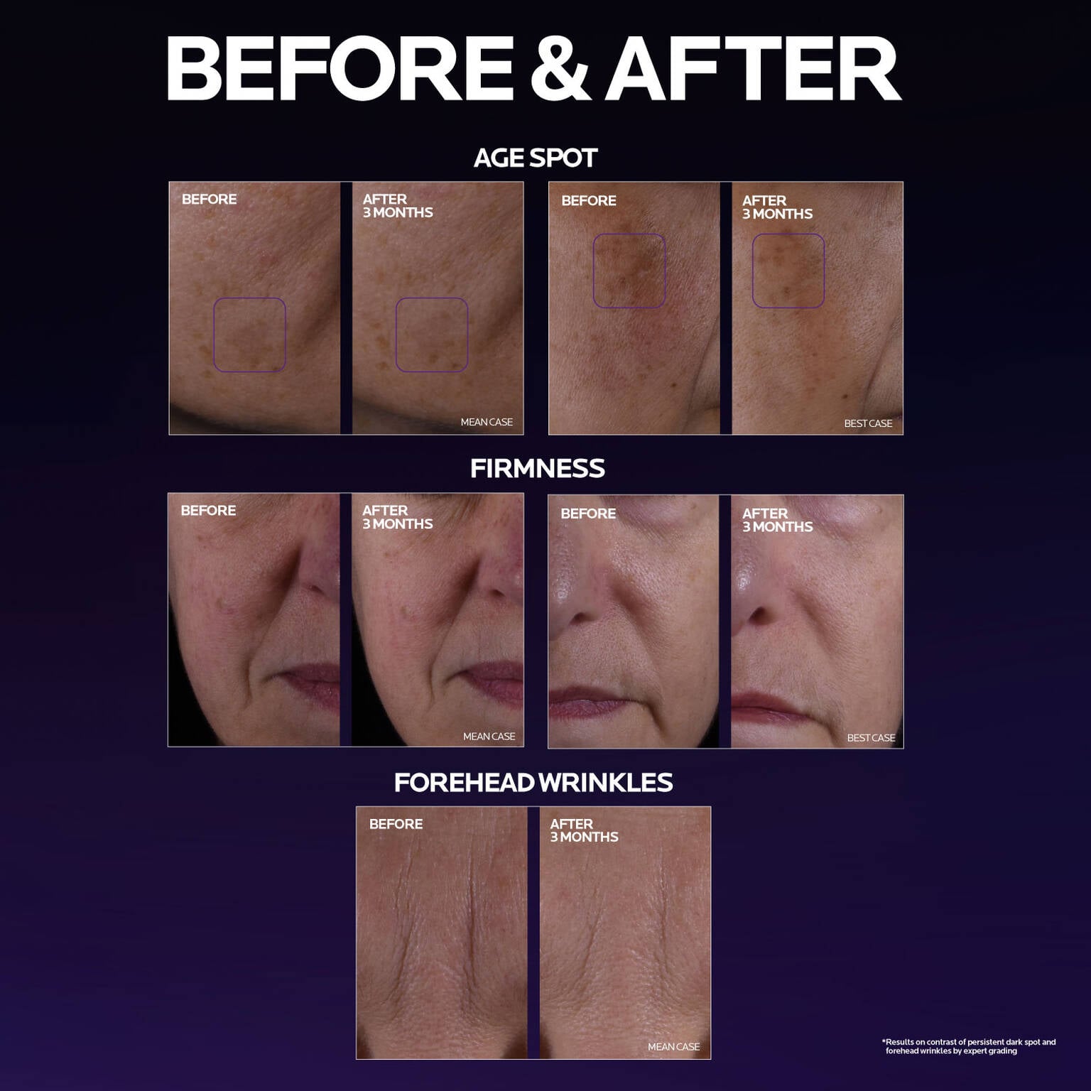 mela-b3-double-dose-discoloration-treatment-with-melasyltm-w6 MelaB3_DD_BTF_BeforeAfter_1500x1500_5.jpg
